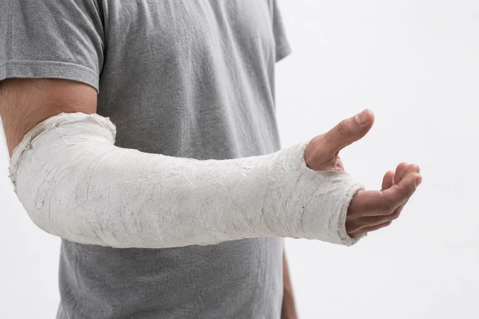 Yeso de escayola tradicional, pesado e incómodo, en un brazo